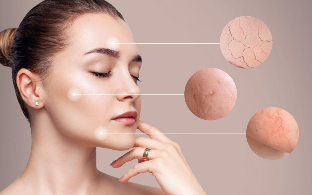 Effektive Hautpflege bei Rosacea