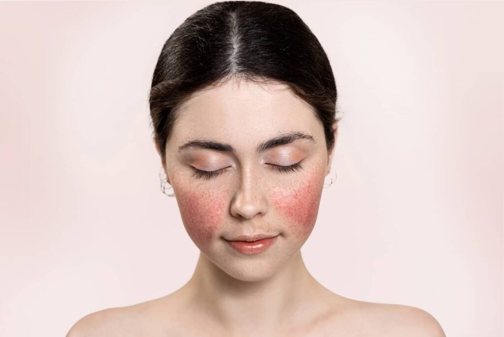 Rosacea und Hautrötungen im Gesicht